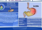 La úlcera de estómago | Recurso educativo 36013