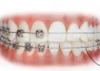 Aparatos fijos de ortodoncia | Recurso educativo 44733