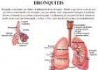 Bronquitis | Recurso educativo 27011